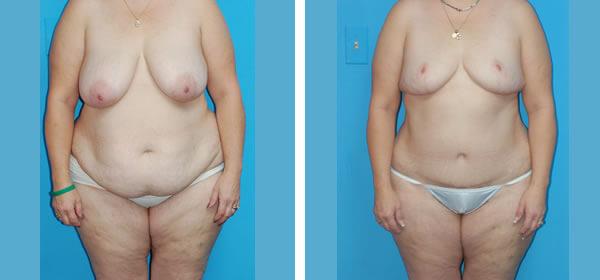 Mommy Makeover result at Boulder Plastic Surgery in Boulder, CO