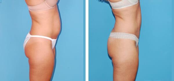 Tummy Tuck result at Boulder Plastic Surgery in Boulder, CO