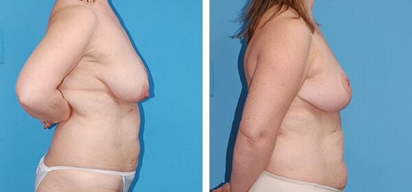 Breast Lift result at Boulder Plastic Surgery in Boulder, CO