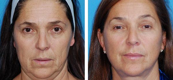 Boulder Plastic Surgery neck lift result — Boulder, CO