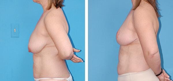 Breast Lift result at Boulder Plastic Surgery in Boulder, CO