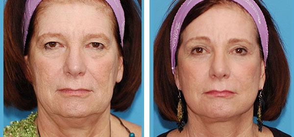 Boulder Plastic Surgery neck lift result — Boulder, CO