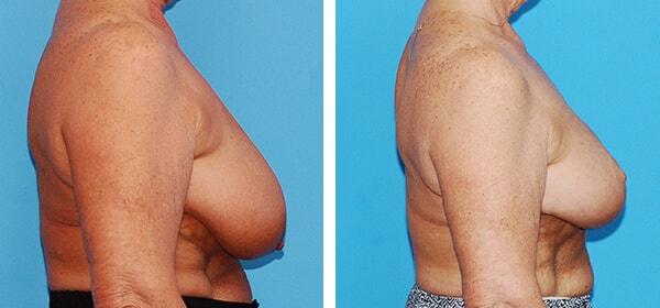 Breast Lift result at Boulder Plastic Surgery in Boulder, CO