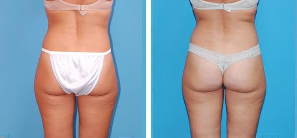 Tummy Tuck result at Boulder Plastic Surgery in Boulder, CO