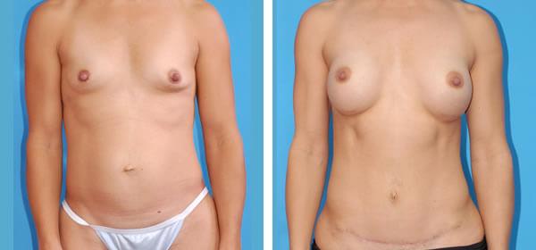 Mommy Makeover result at Boulder Plastic Surgery in Boulder, CO