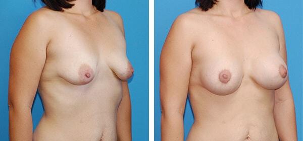 Breast Lift result at Boulder Plastic Surgery in Boulder, CO
