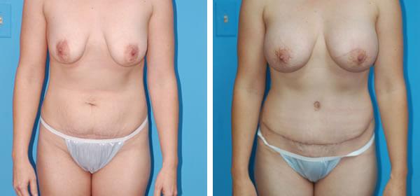 Mommy Makeover result at Boulder Plastic Surgery in Boulder, CO