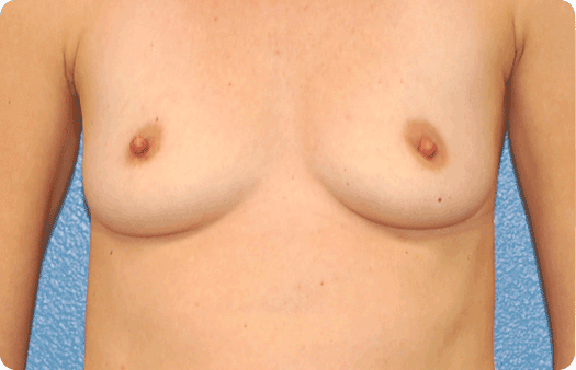 Breast Augmentation before at Boulder Plastic Surgery in Boulder, CO