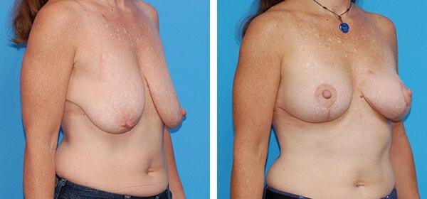 Breast Lift result at Boulder Plastic Surgery in Boulder, CO