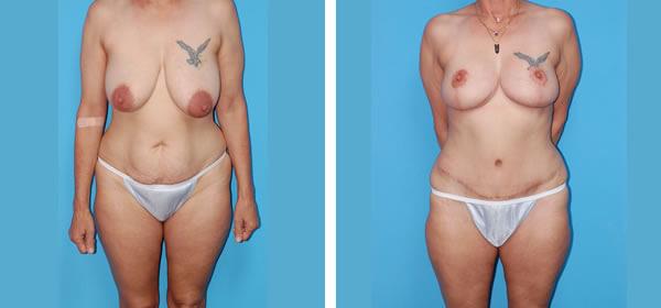Mommy Makeover result at Boulder Plastic Surgery in Boulder, CO