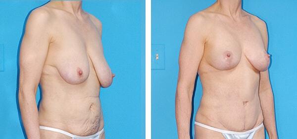 Mommy Makeover result at Boulder Plastic Surgery in Boulder, CO