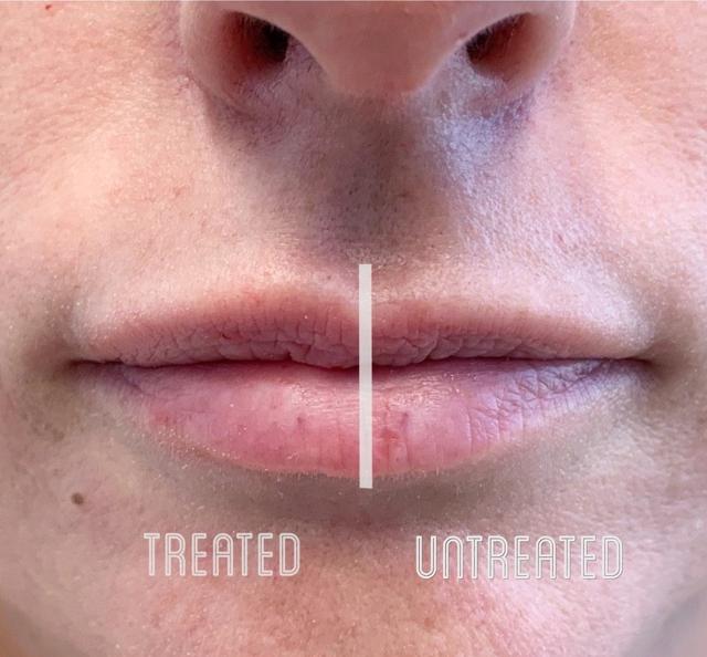 Lip Filler result at Metropolis Dermatology | Costa Mesa in Costa Mesa, CA