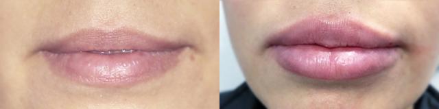 Lip Filler result at Metropolis Dermatology | Costa Mesa in Costa Mesa, CA