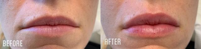 Lip Filler result at Metropolis Dermatology | Costa Mesa in Costa Mesa, CA