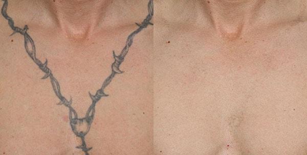 Metropolis Dermatology | Costa Mesa laser treatment result — Costa Mesa, CA