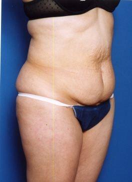 Mini Tummy Tuck before at Sunset Cosmetic Surgery in West Hollywood, CA