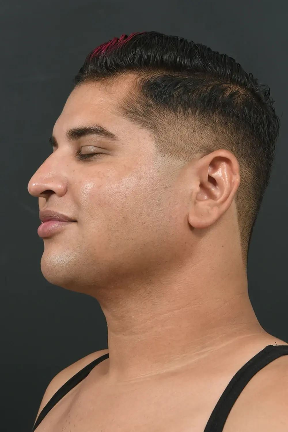 Sunset Cosmetic Surgery liposuction after — West Hollywood, CA
