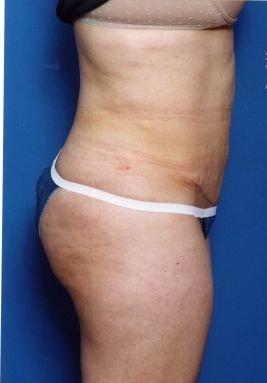 Mini Tummy Tuck after at Sunset Cosmetic Surgery in West Hollywood, CA