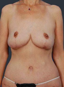 Sunset Cosmetic Surgery body lift after — West Hollywood, CA