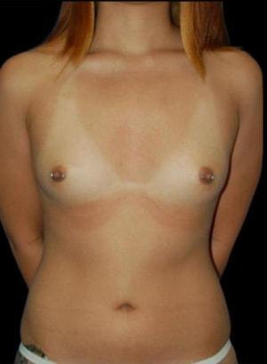 Breast Augmentation before at Sunset Cosmetic Surgery in West Hollywood, CA