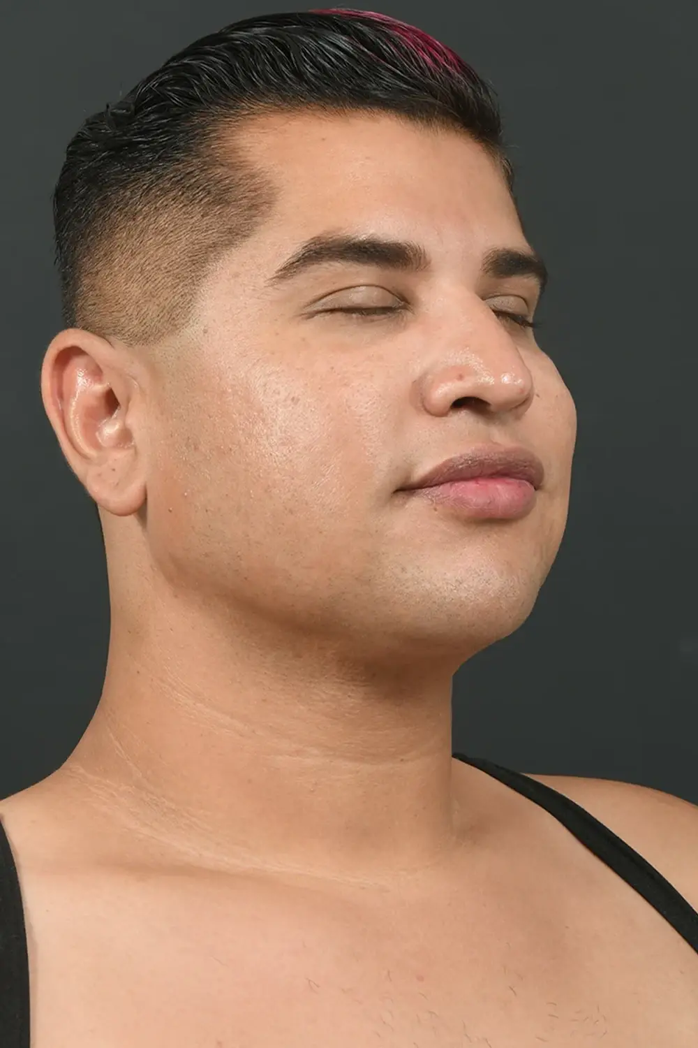 Sunset Cosmetic Surgery liposuction after — West Hollywood, CA