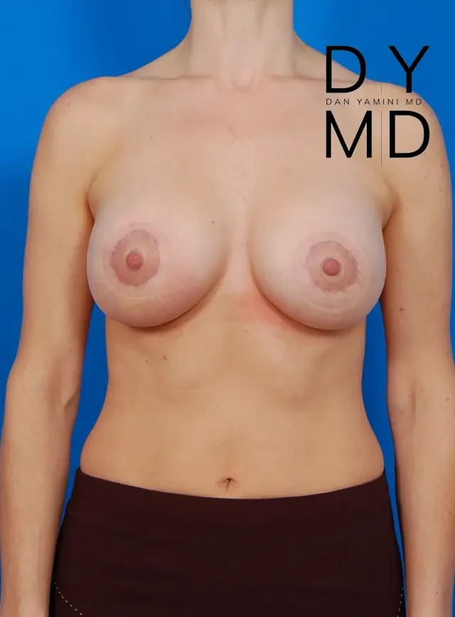Breast Lift after at Sunset Cosmetic Surgery in West Hollywood, CA