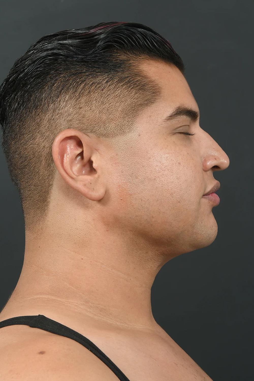 Sunset Cosmetic Surgery liposuction after — West Hollywood, CA
