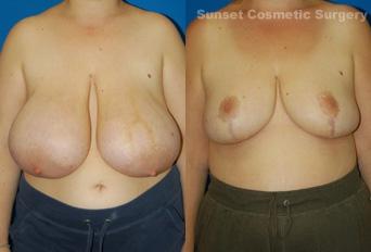 Breast Reduction result at Sunset Cosmetic Surgery in West Hollywood, CA