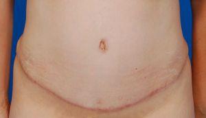 Tummy Tuck after at Sunset Cosmetic Surgery in West Hollywood, CA