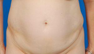 Tummy Tuck before at Sunset Cosmetic Surgery in West Hollywood, CA