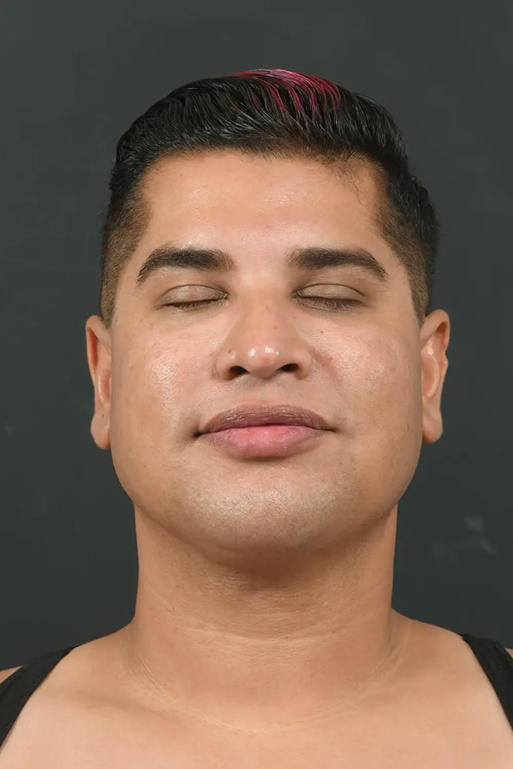 Sunset Cosmetic Surgery liposuction after — West Hollywood, CA