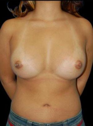 Sunset Cosmetic Surgery breast augmentation after — West Hollywood, CA