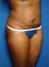 Mini Tummy Tuck before at Sunset Cosmetic Surgery in West Hollywood, CA