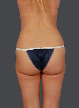 Sunset Cosmetic Surgery bbl after — West Hollywood, CA