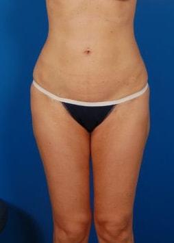 Sunset Cosmetic Surgery bbl after — West Hollywood, CA