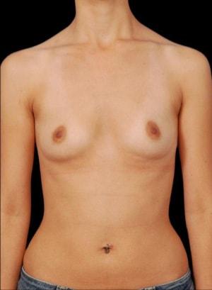 Breast Augmentation before at Sunset Cosmetic Surgery in West Hollywood, CA