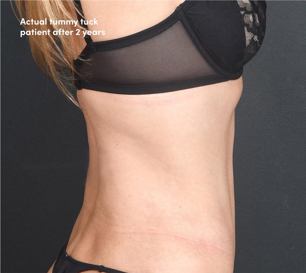 Sunset Cosmetic Surgery liposuction after — West Hollywood, CA