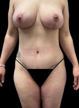 Mommy Makeover after at Sunset Cosmetic Surgery in West Hollywood, CA