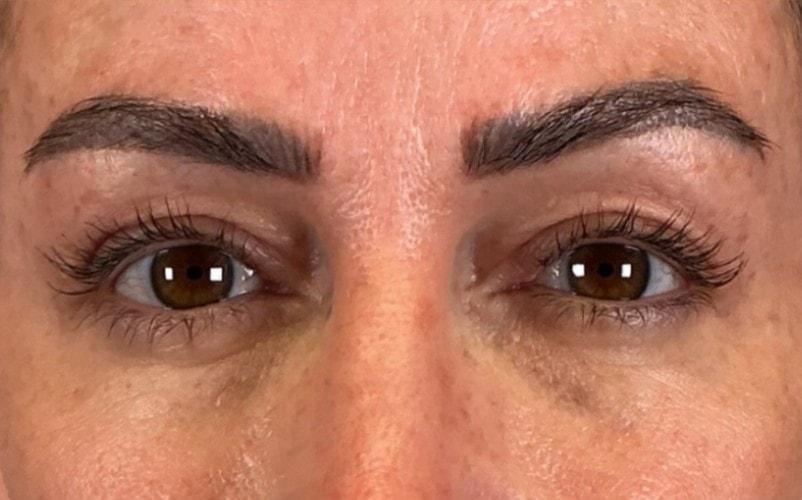 Sharabi Plastic Surgery (Safa Sharabi, MD) eyelid lift after — Santa Monica, CA