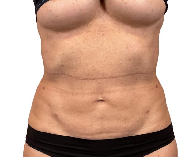 Liposuction after at Sharabi Plastic Surgery (Safa Sharabi, MD) in Santa Monica, CA