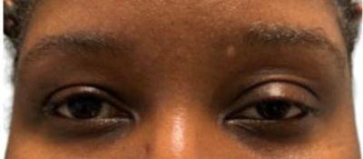 Blepharoplasty before at Sharabi Plastic Surgery (Safa Sharabi, MD) in Santa Monica, CA