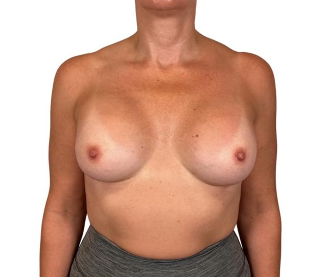 Fat Transfer Breast Augmentation after at Sharabi Plastic Surgery (Safa Sharabi, MD) in Santa Monica, CA