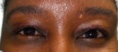 Sharabi Plastic Surgery (Safa Sharabi, MD) eyelid lift after — Santa Monica, CA