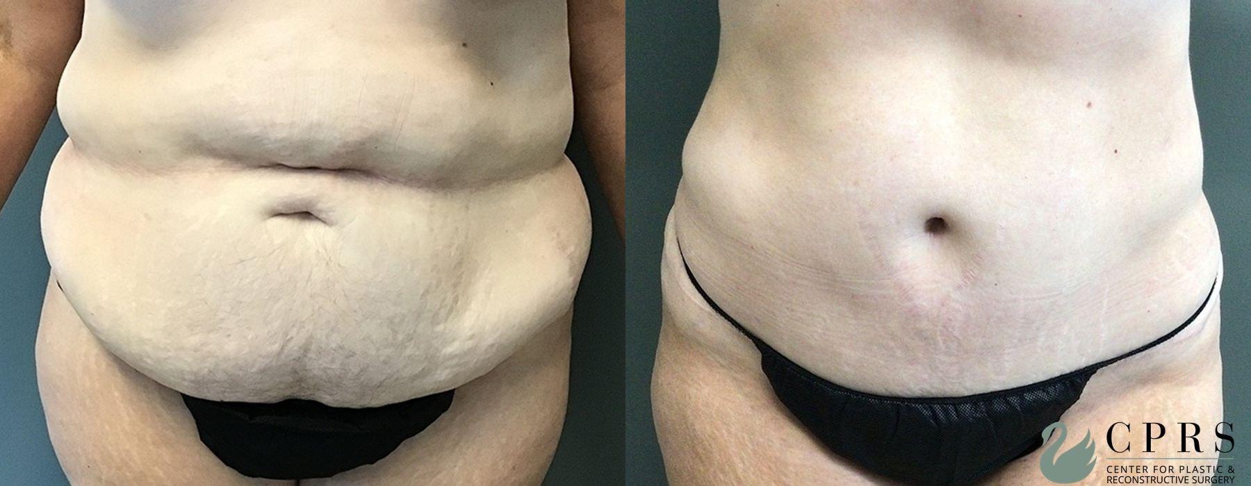 Center for Plastic & Reconstructive Surgery (Kendall Peters, MD) tummy tuck result — Orlando, FL