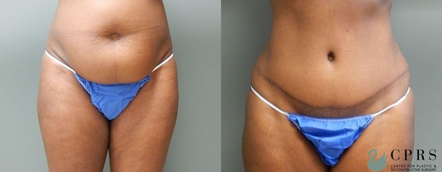 Center for Plastic & Reconstructive Surgery (Kendall Peters, MD) tummy tuck result — Orlando, FL
