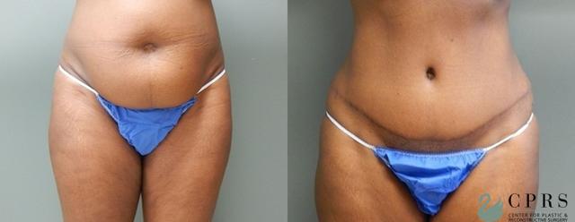 Mini Tummy Tuck result at Center for Plastic & Reconstructive Surgery (Kendall Peters, MD) in Orlando, FL