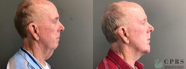 Neck Lift result at Center for Plastic & Reconstructive Surgery (Kendall Peters, MD) in Orlando, FL