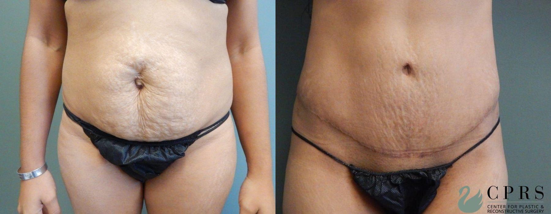 Center for Plastic & Reconstructive Surgery (Kendall Peters, MD) tummy tuck result — Orlando, FL