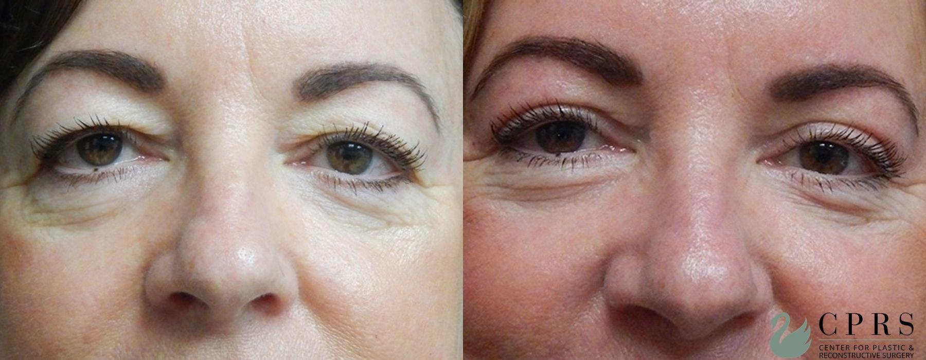 Center for Plastic & Reconstructive Surgery (Kendall Peters, MD) eyelid lift result — Orlando, FL