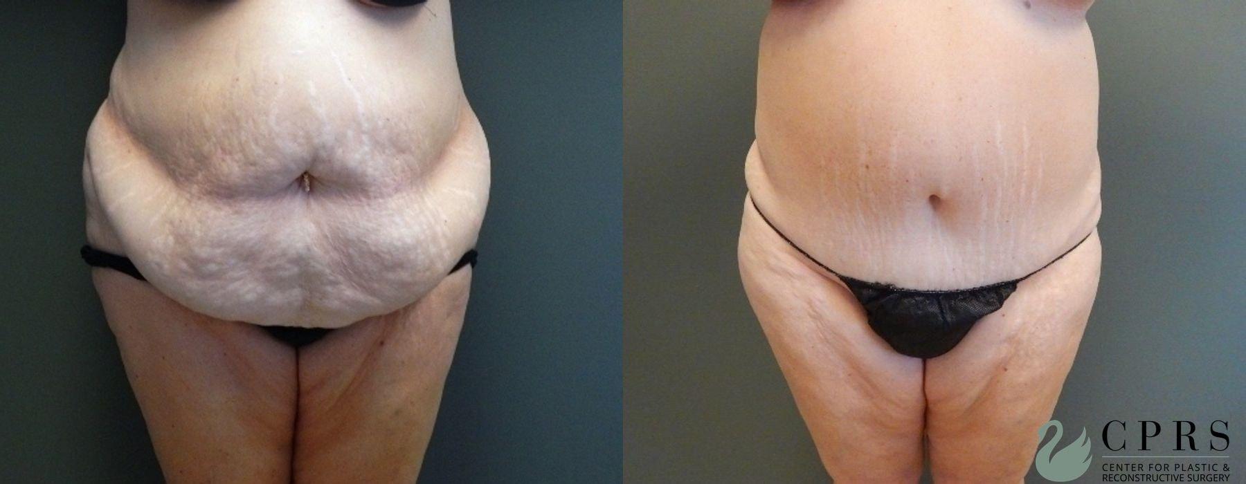 Center for Plastic & Reconstructive Surgery (Kendall Peters, MD) tummy tuck result — Orlando, FL
